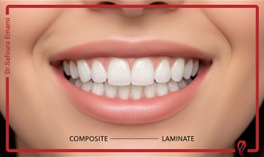 لمینت یا کامپوزیت دندان؟ کدام برای من بهتر است؟